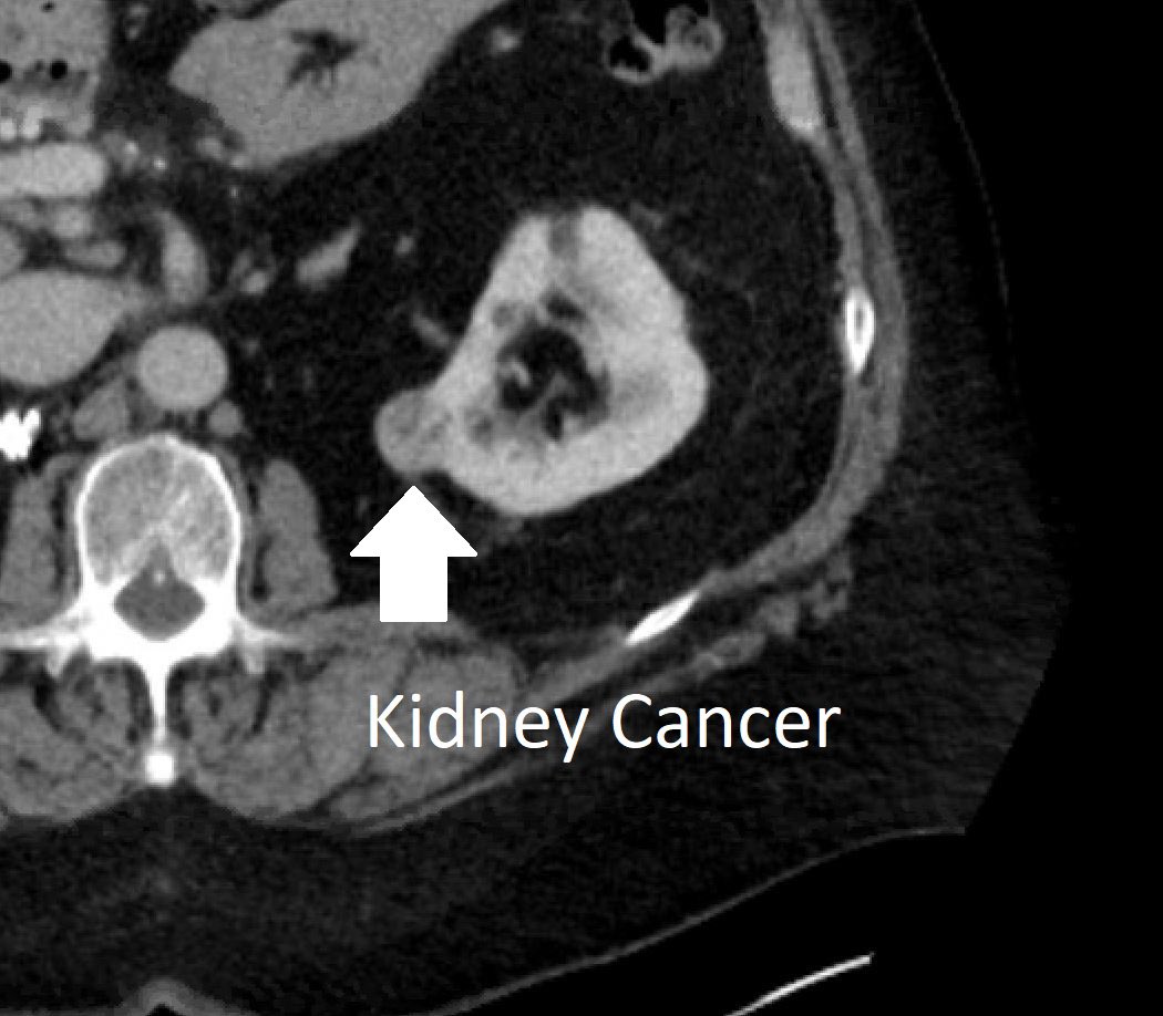 ajgunnmd's tweet photo. If you have #kidneycancer, make sure you speak with an interventional radiologist. While not right for everyone, many tumors can be treated by a needle placed through the skin into the tumor under imaging guidance. This outpatient procedure is safe &amp; effective. #IRad https://t.co/FWfItLqjWs