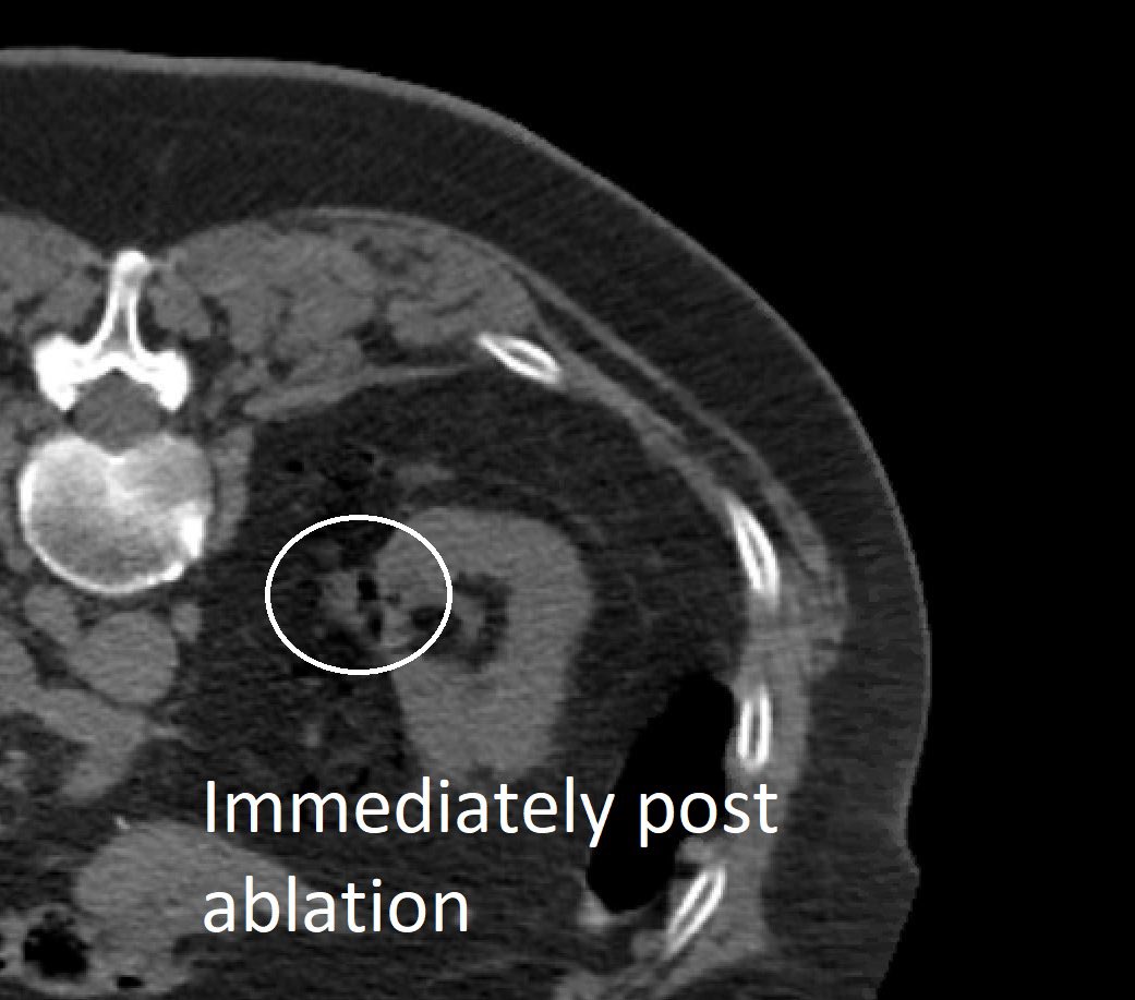 If you have #kidneycancer, make sure you speak with an interventional radiologist. While not right for everyone, many tumors can be treated by a needle placed through the skin into the tumor under imaging guidance. This outpatient procedure is safe &amp; effective. #IRad
