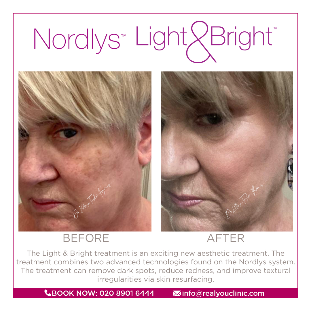 Dr Kathryn "The Light &amp; Bright treatment is an exciting new aesthetic treatment that can remove dark spots, reduce redness, and improve textural irregularities via skin resurfacing. treatment combines