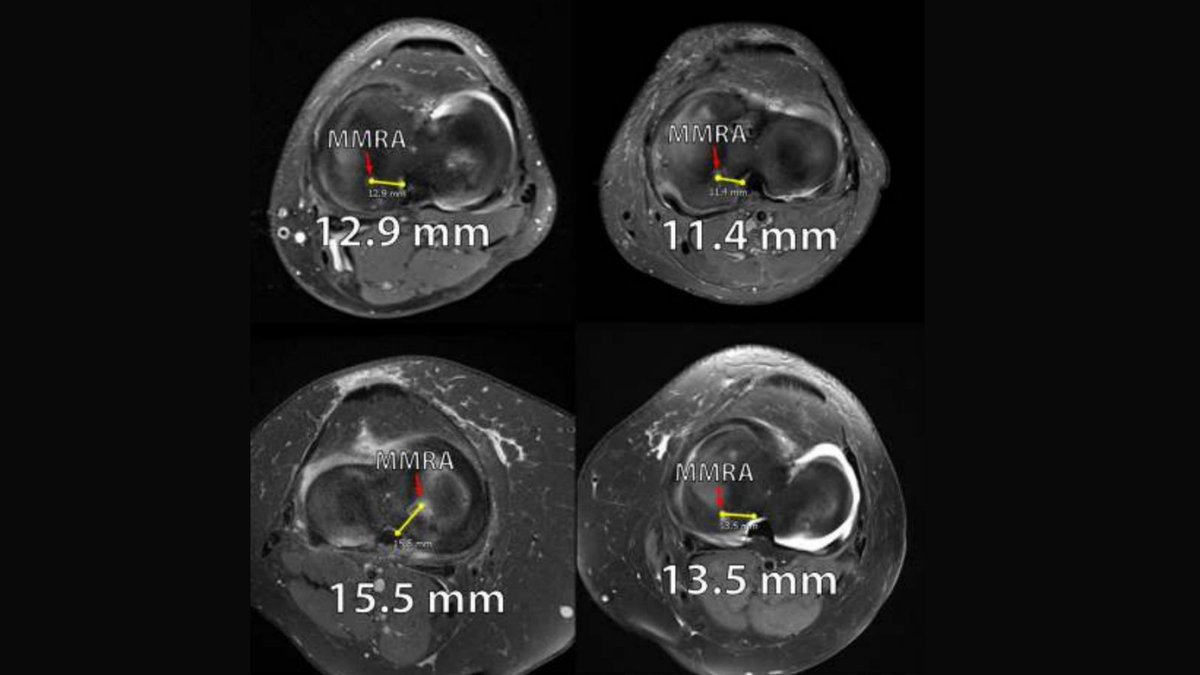 thekneedoc's tweet photo. NEW Dr. LaPrade Study! The Natural History of Medial Meniscal Root Tears: A Biomechanical and Clinical Case Perspective. https://t.co/oTlVgyxEtN #medtwitter #meniscus #meniscusroottear #savethenmeniscus https://t.co/tJwirVADhy