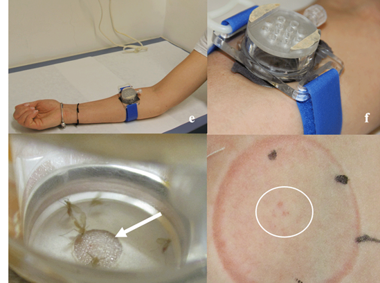 A clinical study using uninfected sand flies, on the pathway to a controlled human infection model for leishmaniasis:
wellcomeopenresearch.org/articles/6-168…
<a href="/v1vak/">Vivak Parkash</a> <a href="/Profgljones/">Georgina Jones</a> @medvla <a href="/WellcomeOpenRes/">WellcomeOpenResearch</a>