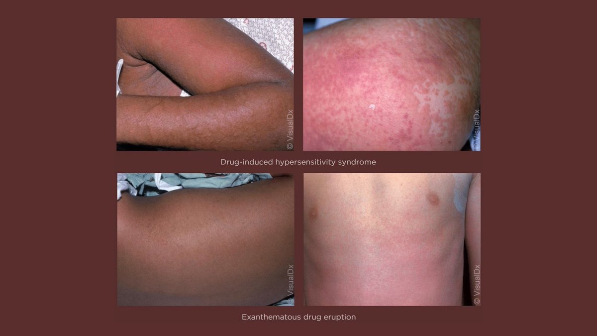 ProjectIMPACT__'s tweet photo. Exanthematous drug eruption and drug-induced hypersensitivity syndrome present subtleties across light and dark skin. Are you able to make the diagnosis? #DrugEruption #MedTwitter #DermTwitter #HealthEquity #ProjectIMPACT #LightSkin #DarkSkin #FitzpatrickScale #dermatology https://t.co/AVf04L1VqR