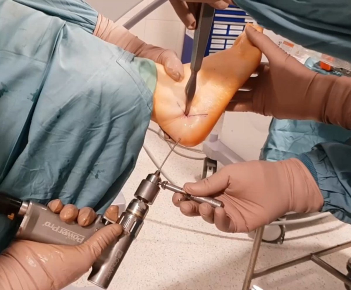 drjoseptorrent's tweet image. 1st International symposium Foot &amp;amp; Ankle Trending Topics
➡️ Charla sobre la Osteotomía Percutánea de Calcáneo
🔥 Técnica segura, reproducible y Mínimamente Invasiva

Gracias por la invitación Dra Tania Mann &amp;amp; Dr Gustavo Nunes

#calcaneus #trendy #MIS #percutaneous #foot #ankle