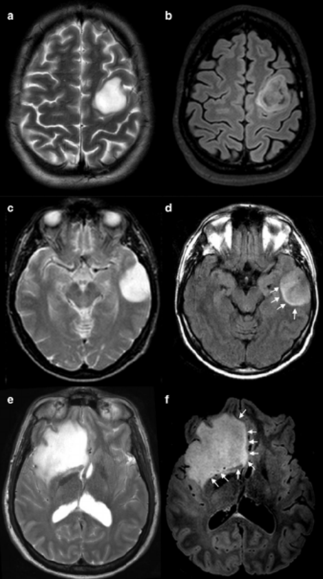 BJR_Radiology's tweet photo. T2-FLAIR mismatch sign: a roadmap of pearls and pitfalls
https://t.co/PzLS2YjUm2
#Radiology @catmendespinto https://t.co/KjmaLNkjS2
