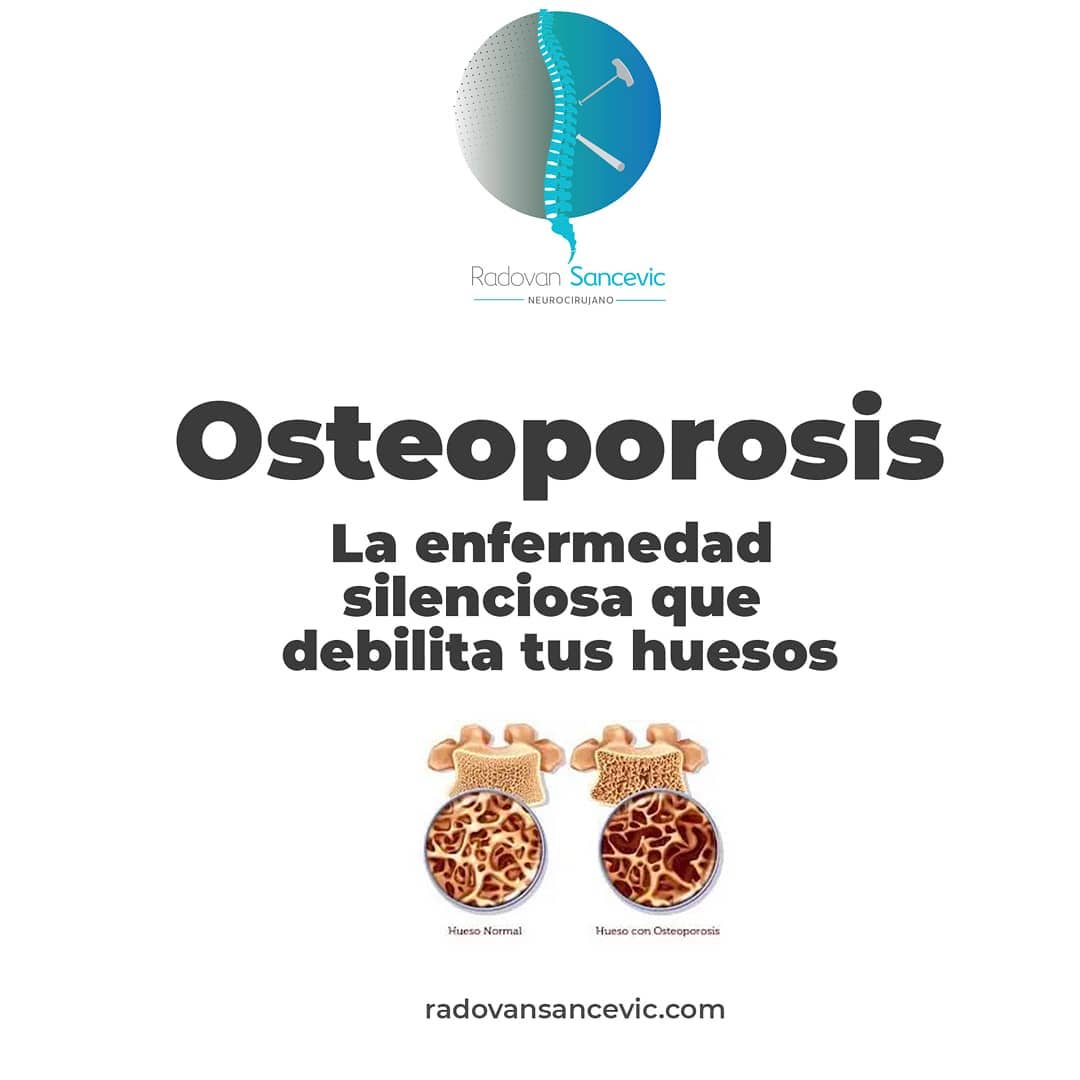 RadovanSancevic's tweet photo. La osteoporosis es una enfermedad “silenciosa”, que se va instaurando sin provocar síntomas en el paciente. https://t.co/Xn6oplNWy5