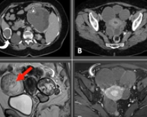 diagnostico911's tweet photo. Lesiones Quísticas del Abdomen y Pelvis Abordaje y correlación anatomopatológica- https://t.co/L5pPBuwgmQ https://t.co/0q1zdJgcKk