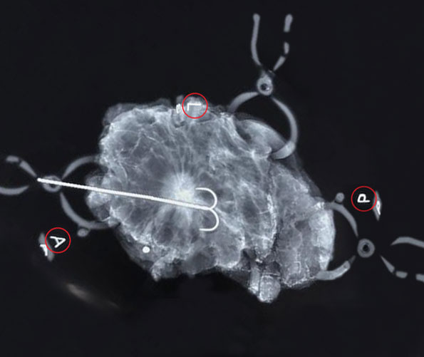 VectorSurgical's tweet image. #CorrectClips are radiographic markers used to orient excised tissue on the intraoperative image. Visit VectorSurgical.com to request a sample.