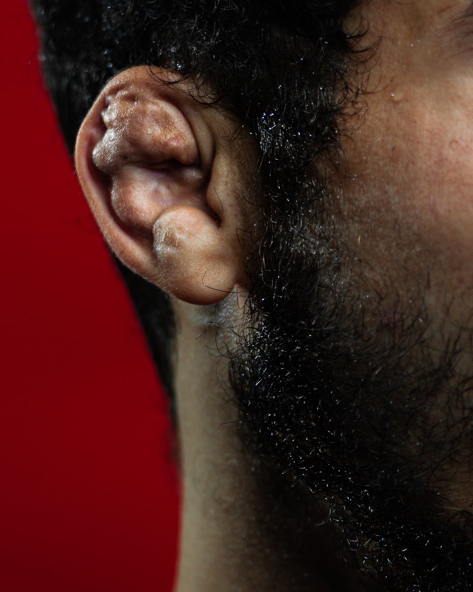 wrestling's tweet photo. Our badges of honor!👂#CauliflowerEar https://t.co/dLzKLTvn6n