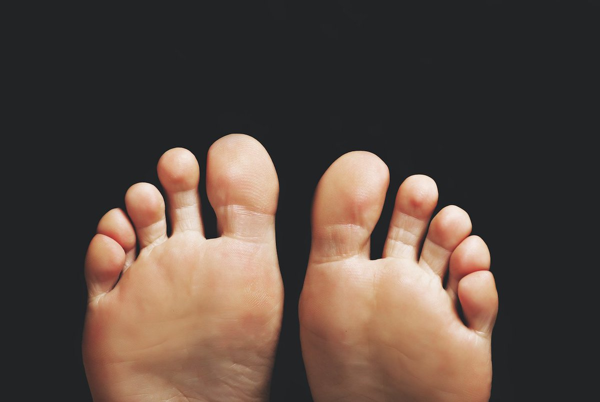 The #FootHealth Show with #Podiatrists <a href="/PeterAllton/">Peter Allton</a> <a href="/circlepodiatry/">Circle Podiatry</a> on <a href="/ukhealthradio/">UK Health Radio™</a> - This week Peter shares things that can go wrong with your little Pinky toe.

👉🏼 🎧 bit.ly/2SVemGr #healthyfeet #healthytoes #healthytoe