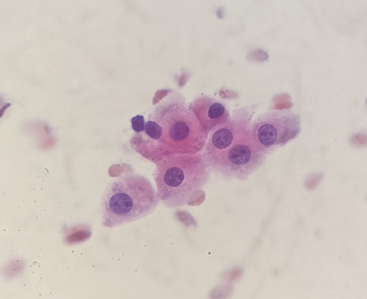 FNA from bening Breast pathology Apocrine cells: Big cells, with abundant cytoplasm, round nucleus with nucleoli. This cells are present in cystic, fibrocystic condition, also fifroadenomas, and Papillary lesion. #breastpath #cytopath