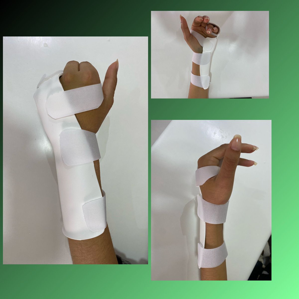 Órtese para fratura do quinto metacarpiano.