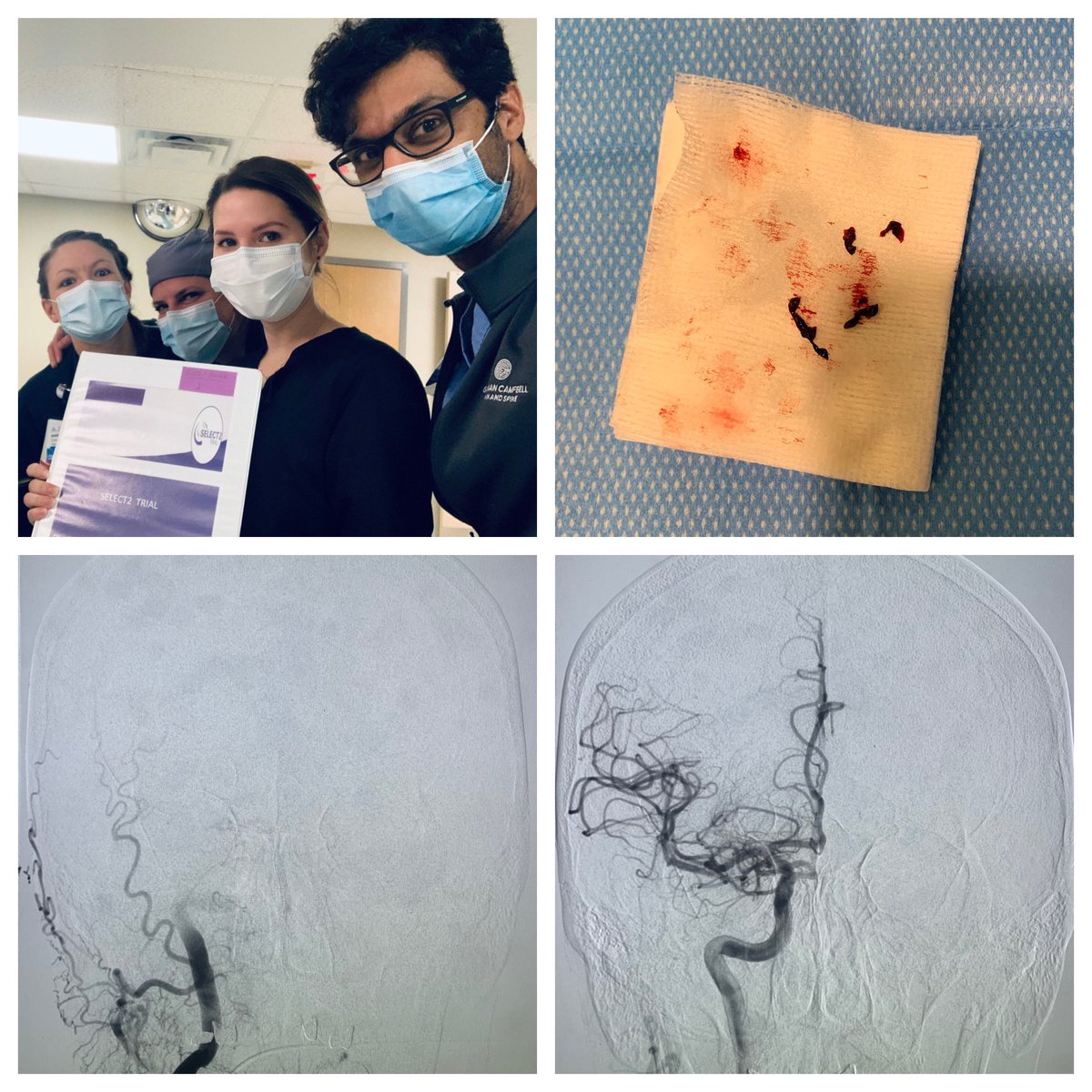 AmuluruKrishna's tweet photo. Our first SELECT2 trial recruitment; wake-up stroke with a right ICA occlusion, ASPECT 4, randomized to thrombectomy. One pass TICI3 recanalization. Thank you to our amazing research team!

#Stroke #EndovascularNeurosurgery #SELECT2 #NoELVOLeftBehind https://t.co/8YUA1iPlZ5