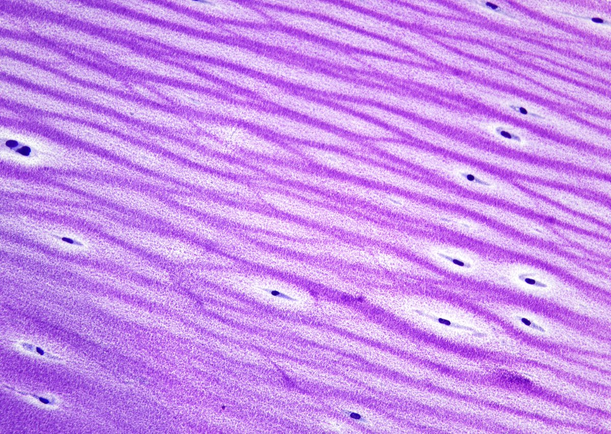 sza_jhcyto's tweet photo. "Sand dunes or wavy ocean" - Myxofibrosarcoma on FNA with granular matrix and trapped bipolar spindled cells. https://t.co/Vfpb6Afur6