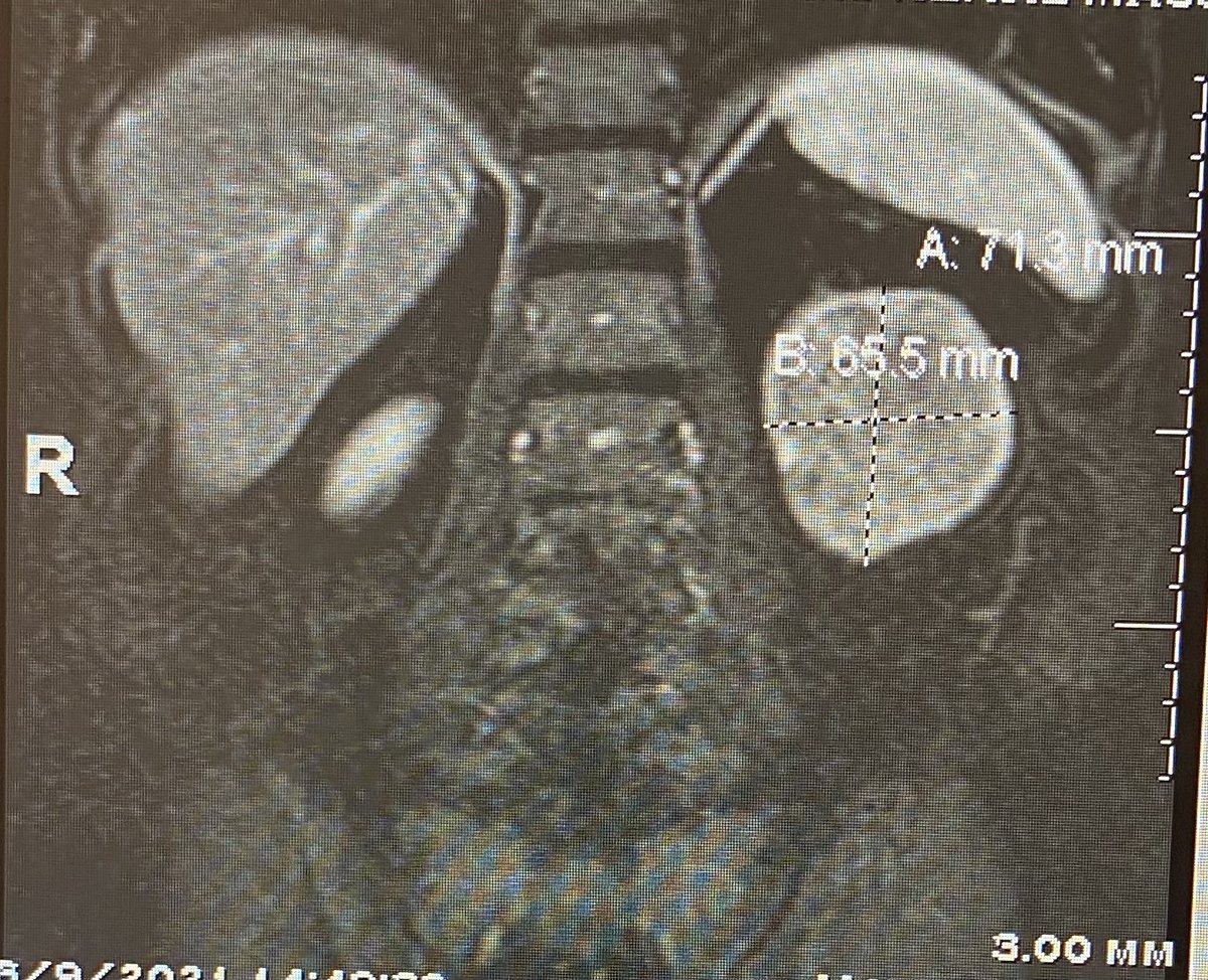 RajNarayanan67's tweet photo. #Embolization of a 7 cm #Angiomyolipoma in the left kidney @MiamiVasc. Follow up with reduction in size and no solid enhancing component @SIRmembers @ISVIRIndia #embozene @BSIR_News @BaptistHealthSF @BradleyFox34 @bostonsci @DrKoethe @YixuanYuki @drvarshana https://t.co/rNQDlVLm9N