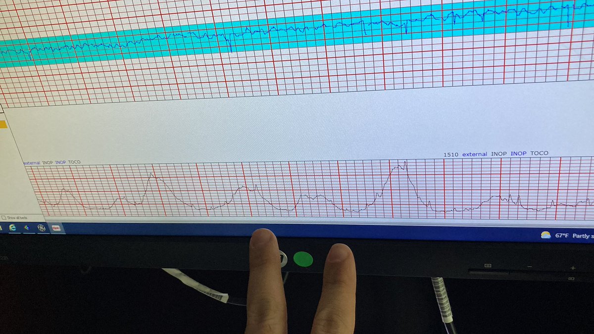 JKR_Duo's tweet photo. 14mU/min to try and smooth out contractions which are coming in doubles. https://t.co/C4mFkCzwqz
