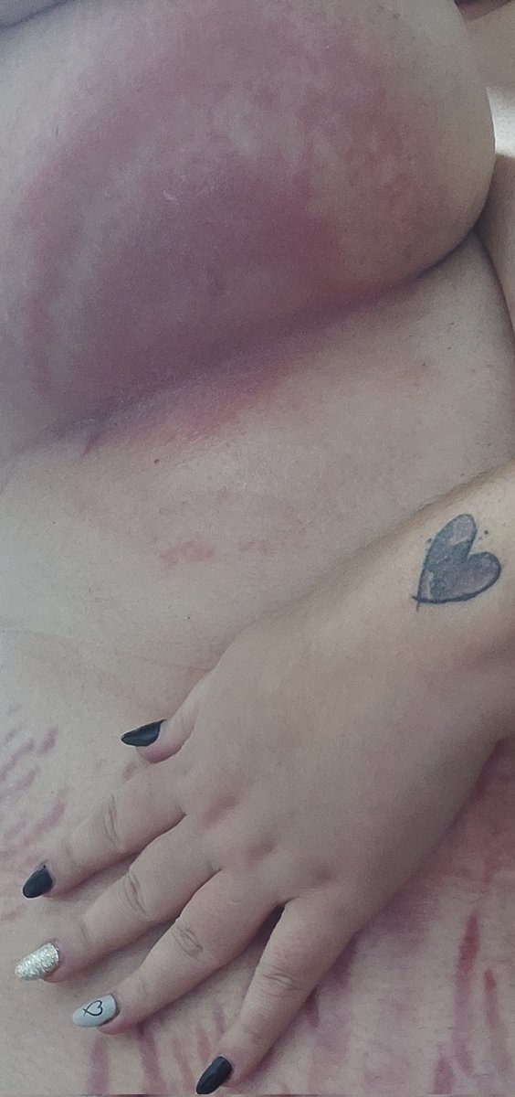 Iris_CU93's tweet photo. ‼️La dermatóloga sigue sin llamarme🤬‼️
Pues así siguen avanzando 😔... Y añado que no solo son las del pecho 😓.... Asique os muestro "mi maravillosa" piel 🥲
La #Leona🦁 hasta el #Xixi🙃... #DiceQueNoEsUrgente🤬... Pues aquí lo "NO" urgente 🤬 https://t.co/fSoCrpOroZ