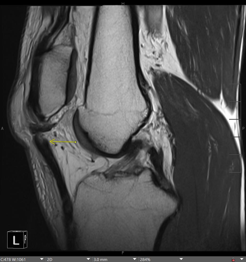 RADIOGRAPHY-MRI CORRELATION: Traumatic proximal patella tendon avulsion. The radiograph shows patella alta. DIXON images help to differentiate osseous from this tendinous avulsion. Short arrow indicates hemorrhagic bursitis. @ssr_rwg @SSRbone @MskSerme @intskeletal @ESSRmsk