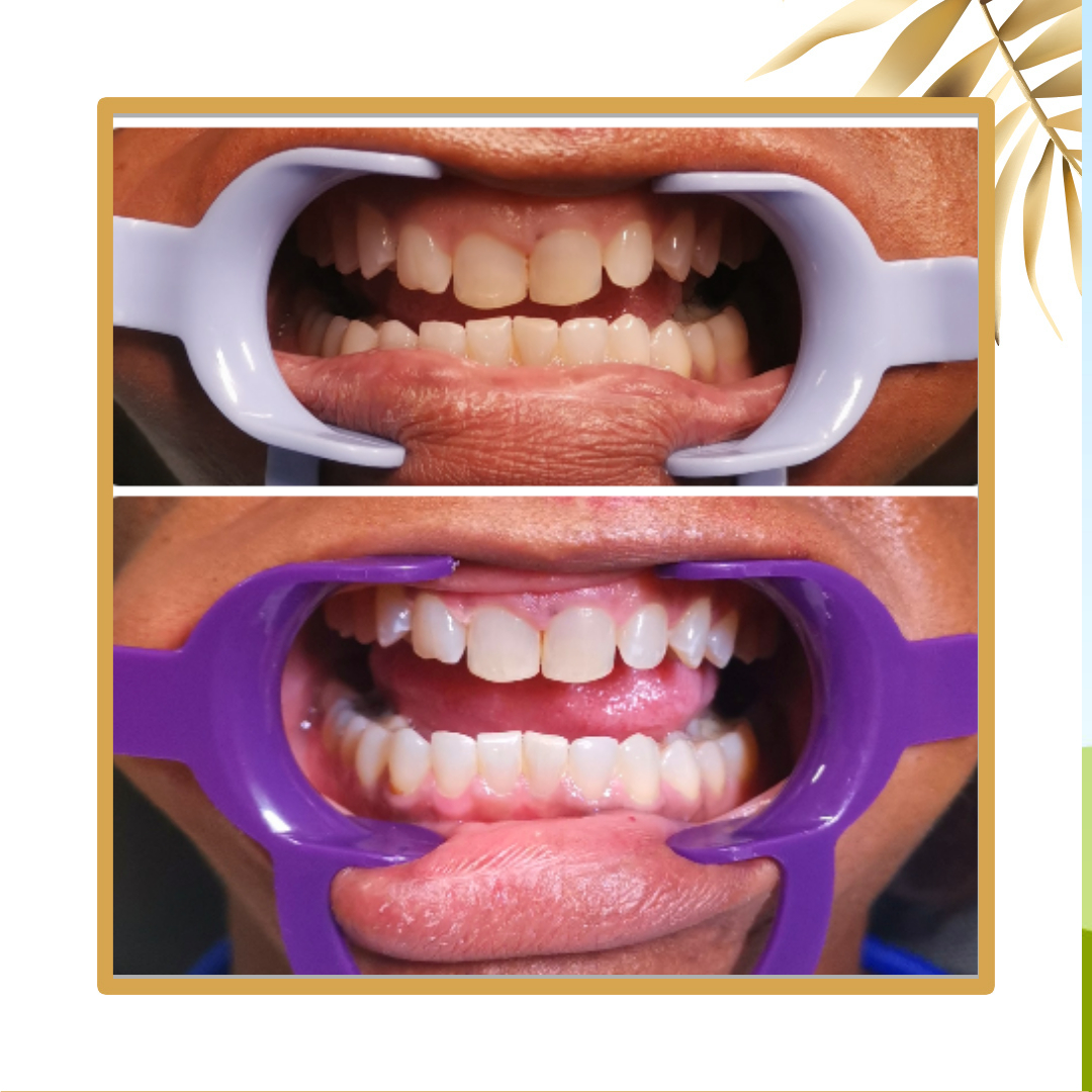 BeyondBBVIP's tweet image. 📢📢IT'S HAPPY SMILE MONDAY, SHE'S HAPPY WITH HER NEW SMILE: YOU SHOULD BE TOO!😎😁

Who would like to answer why are white teeth attractive? 🙋🏾‍♀️🙋‍♀️🙋🏼‍♀️

Generally, white teeth indicate good health and good genes, while yellow has the