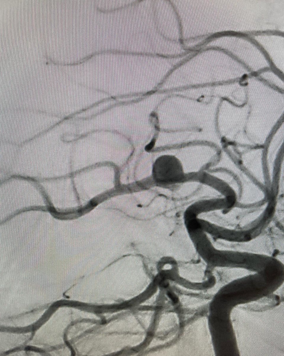 VascNeuro's tweet photo. 81F, found with an unruptured left MCA aneurysm, aneurysm shape appeared to be a blowout rather than a saccular aneurysm with no true neck. Measured 7.1 x 5.4 mm. Treated with a pipeline device. Looking forward to follow-up imaging. #loveneuro #neuroscience #neurology https://t.co/Cs9RO0zNu2