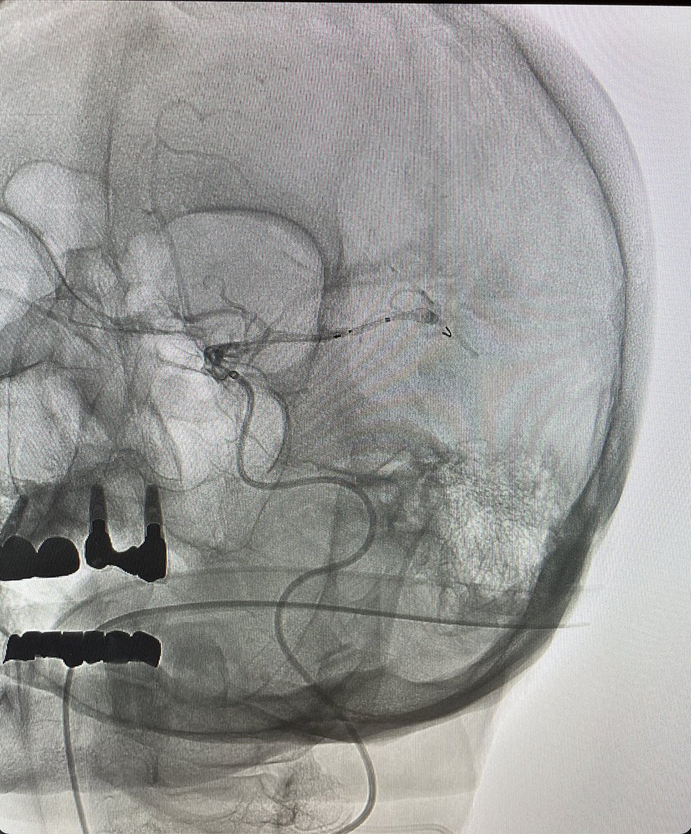 VascNeuro's tweet photo. 81F, found with an unruptured left MCA aneurysm, aneurysm shape appeared to be a blowout rather than a saccular aneurysm with no true neck. Measured 7.1 x 5.4 mm. Treated with a pipeline device. Looking forward to follow-up imaging. #loveneuro #neuroscience #neurology https://t.co/Cs9RO0zNu2