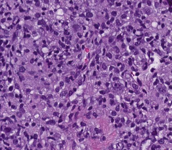 SibaElHussein's tweet photo. #LessonsFromtheFridayUnknowns T-cell histiocyte-rich large B-cell lymphoma with unusual CD30 expression, shown to us by @ljmedeirosMD during #LJMFridayUnknowns ➡️https://t.co/wPhotCi38A #hemepath #lymsm #PathTwitter @KirillLyapichev @RMirandaMD https://t.co/33g9koJ04K