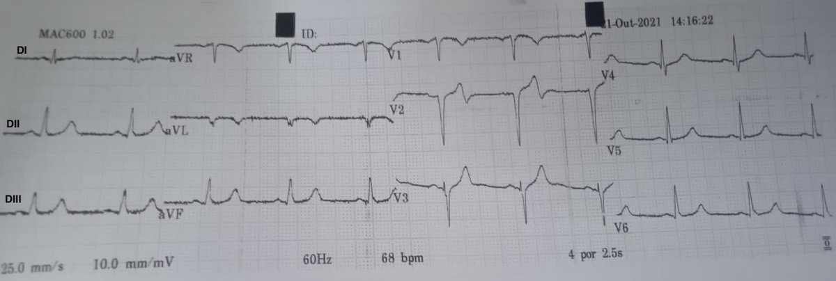 evandrofilhobr's tweet image. 35👨‍🔧, no risk factors for CAD. Arrived with 7h recurring typical CP pain and important elevation of hs-Troponin. EKG above. Denied drug abuse or anything else...#ICFIT