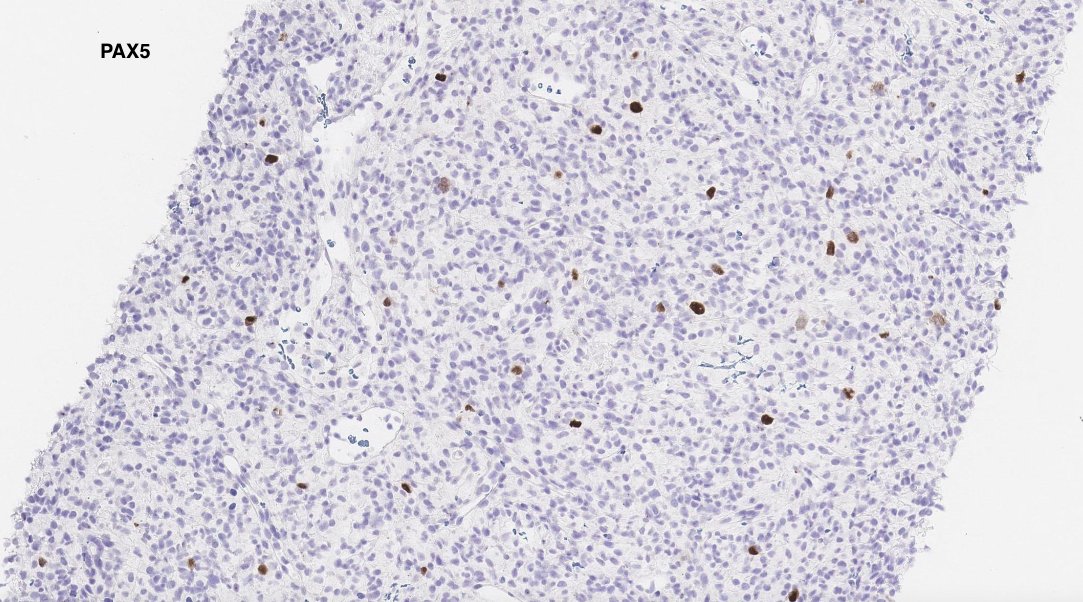 SibaElHussein's tweet photo. #LessonsFromtheFridayUnknowns T-cell histiocyte-rich large B-cell lymphoma with unusual CD30 expression, shown to us by @ljmedeirosMD during #LJMFridayUnknowns ➡️https://t.co/wPhotCi38A #hemepath #lymsm #PathTwitter @KirillLyapichev @RMirandaMD https://t.co/33g9koJ04K