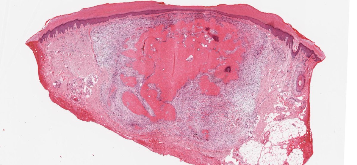 Two  ossifying cutaneous tumours on PathPresenter as "ossifying fibromyxoid tumour".  But they are quite different (pattern of ossification and arrangement of cells). The second is an example of ossifying plexiform tumour  journals.lww.com/amjdermatopath…
#pathology #dermatopathology