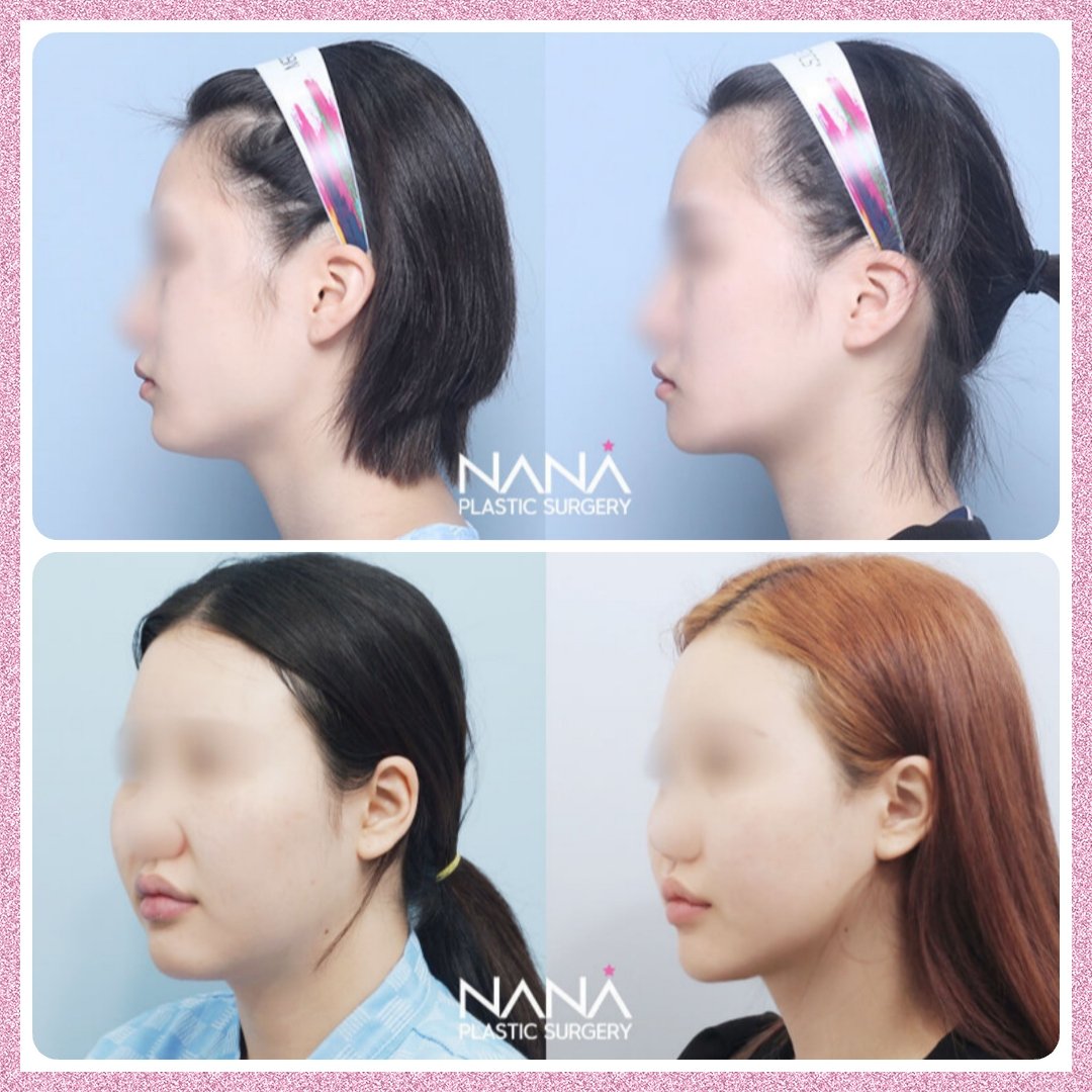 韓国整形nana美容外科 Nanahospital Timeline The Visualized Twitter Analytics 韓国整形nana美容外科 Nanahospital Timeline The Visualized Twitter Analytics
