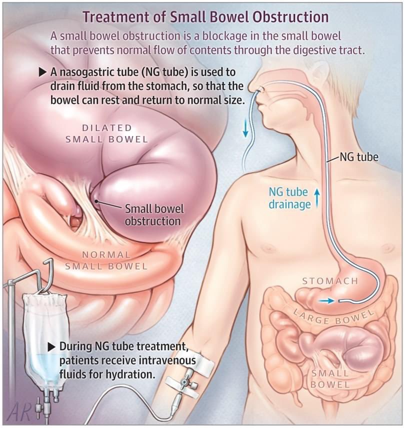 #SmallBowelObstruction

A small bowel obstruction is a blockage in the small intestine 

instagram.com/p/CVedl73NQLk

#IntestinalObstruction #AbdominalPain #Vomiting #AbdominalDistension