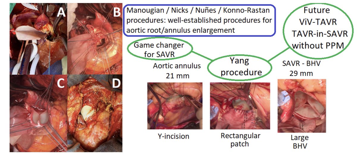 M_Pompeu_Sa_MD's tweet photo. 🔥Hot off the press🔥 Read our paper just published in @JCardSurg: https://t.co/al4vzBRMux

💪Collaboration with @BaselRamlawiMD @GianTorre610 @SSicouri @QasimAbri #JKempfert #VFalk #MKofler @AUnbehaun @KarelPraet

💥@LankenauCVSurg🇺🇸 @HMethodistCV🇺🇸 @dhzberlin🇩🇪 @ChariteBerlin🇩🇪 https://t.co/AmZta19Hu1