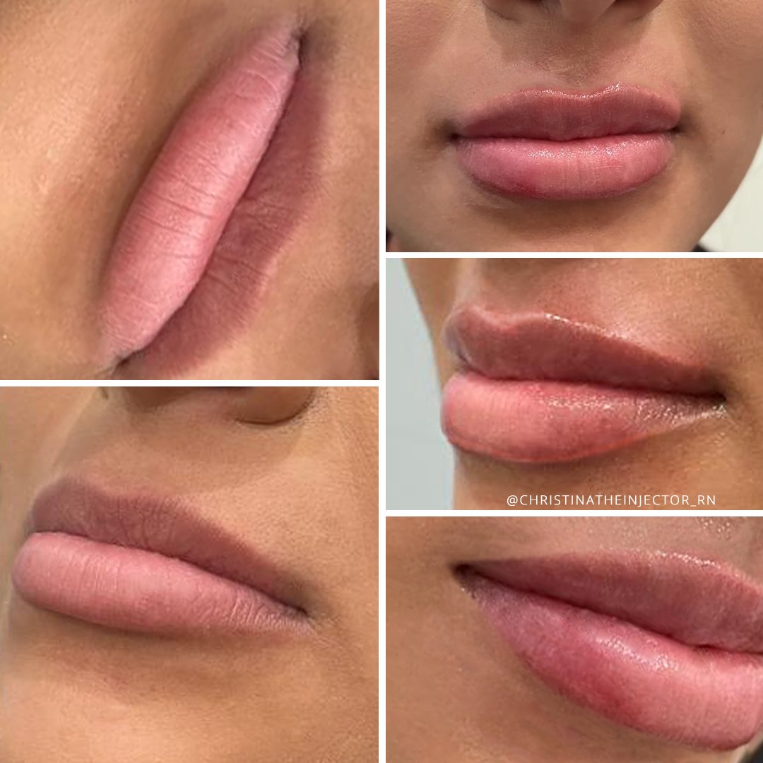 GeminiPlastics's tweet photo. #LipFillers #001-006
Fuller #lips has been achieved. Look at these gorgeous lips.
Book w/ Christina, RN on Thurs, Sat!
https://t.co/lIbwlouYHD
Christina Macias, RN · Registered Nurse & #MasterInjector
Gemini #PlasticSurgery Aesthetic & #Laser Center · #MedSpa
#RanchoCucamonga https://t.co/6UfFcj3SMS