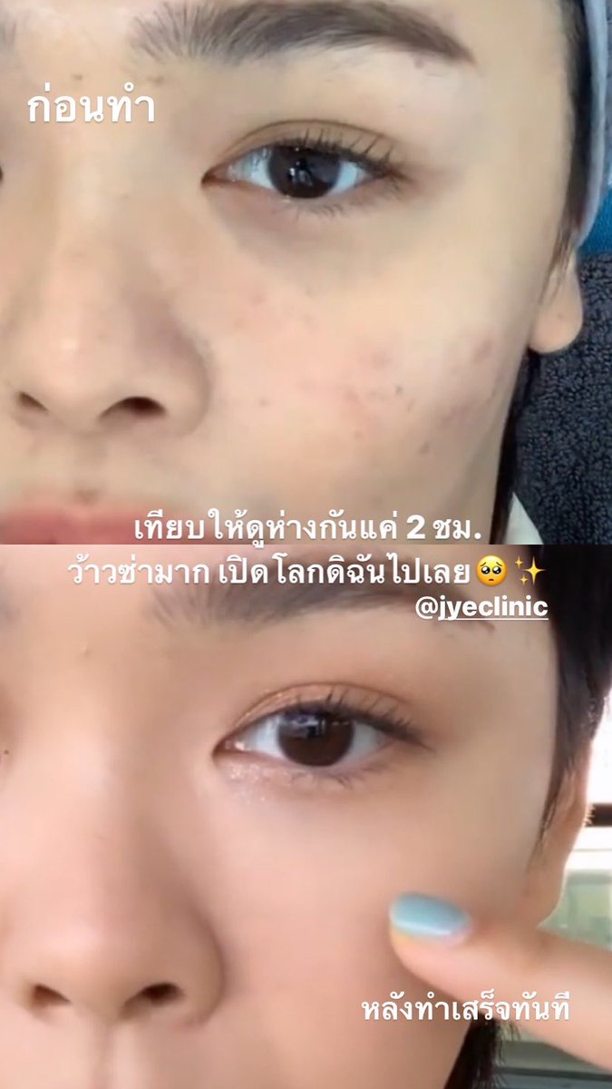 KIKI48_xx's tweet photo. ฟิลเลอร์ใต้ตาครั้งแรกในชีวิต ก่อนหน้านี้กลัวมากไม่กล้าทำ แต่พอลองทำแล้วว้าวซ่ามากกกก อห. ดีแบบนี้ผมมาทำนานแล้วคับ 😭💕 https://t.co/WPhgEOVLQf