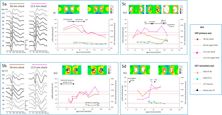 ISCEV (@iscev_org) on Twitter photo Giant pattern #VEPs in children - when do they matter? sciencedirect.com/science/articl…
<a href="/BriSCEV/">BriSCEV</a> <a href="/O_Marmoy/">Oliver Marmoy</a> <a href="/GoshSight/">Great Ormond Street Hospital Eye Department</a> <a href="/GOSH_NeuroSurg/">Great Ormond Street Neurosurgery</a> <a href="/UCLchildhealth/">UCL Great Ormond Street Institute of Child Health</a> Giant pattern #VEPs in children - when do they matter? sciencedirect.com/science/articl…
<a href="/BriSCEV/">BriSCEV</a> <a href="/O_Marmoy/">Oliver Marmoy</a> <a href="/GoshSight/">Great Ormond Street Hospital Eye Department</a> <a href="/GOSH_NeuroSurg/">Great Ormond Street Neurosurgery</a> <a href="/UCLchildhealth/">UCL Great Ormond Street Institute of Child Health</a>