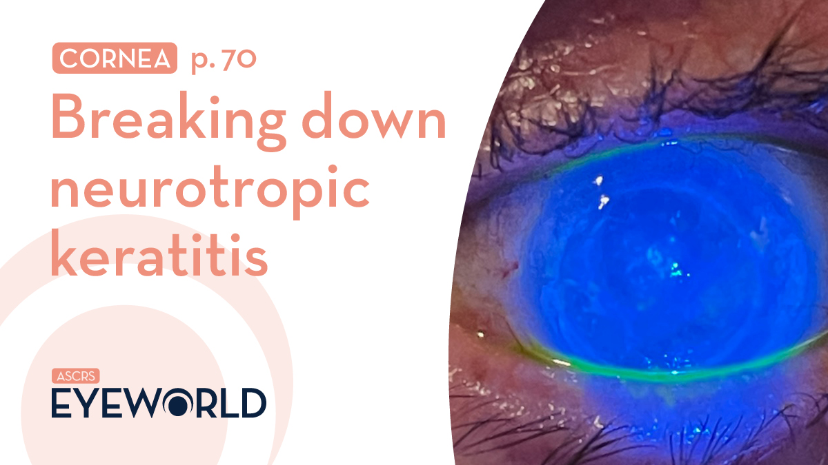 ASCRStweets's tweet photo. Neurotrophic keratitis presents a lot to consider in staging, diagnosis, and treatment. Three experts discussed with #EyeWorld how they work up NK - https://t.co/eSjQuSzZrz https://t.co/is3daJvAyC
