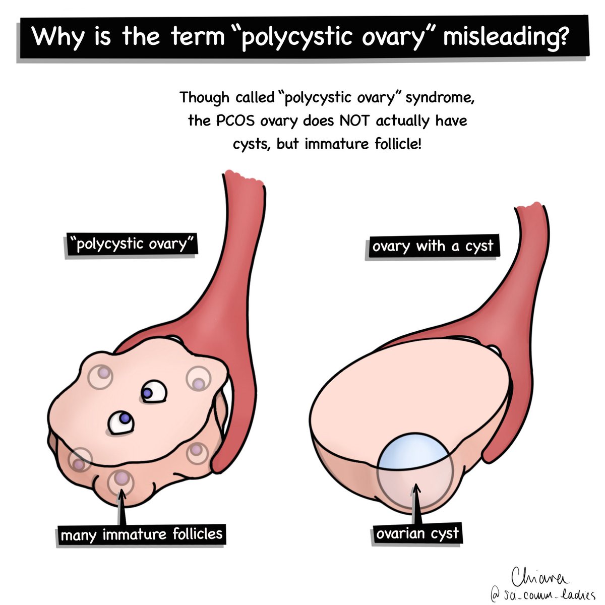 Q:Why is the term “polycystic ovary syndrome” misleading? 

A:Women with #PCOS do not have cysts in their ovaries, while some women without the disorder do develop cysts.

Post created in collaboration with <a href="/DaisyPcos/">DAISy-PCOS</a> <a href="/Thais_P_Rocha/">Thaís Pagliaro Rocha</a> @GalacticZoo

 #pcosawareness #scicomm #SciArt