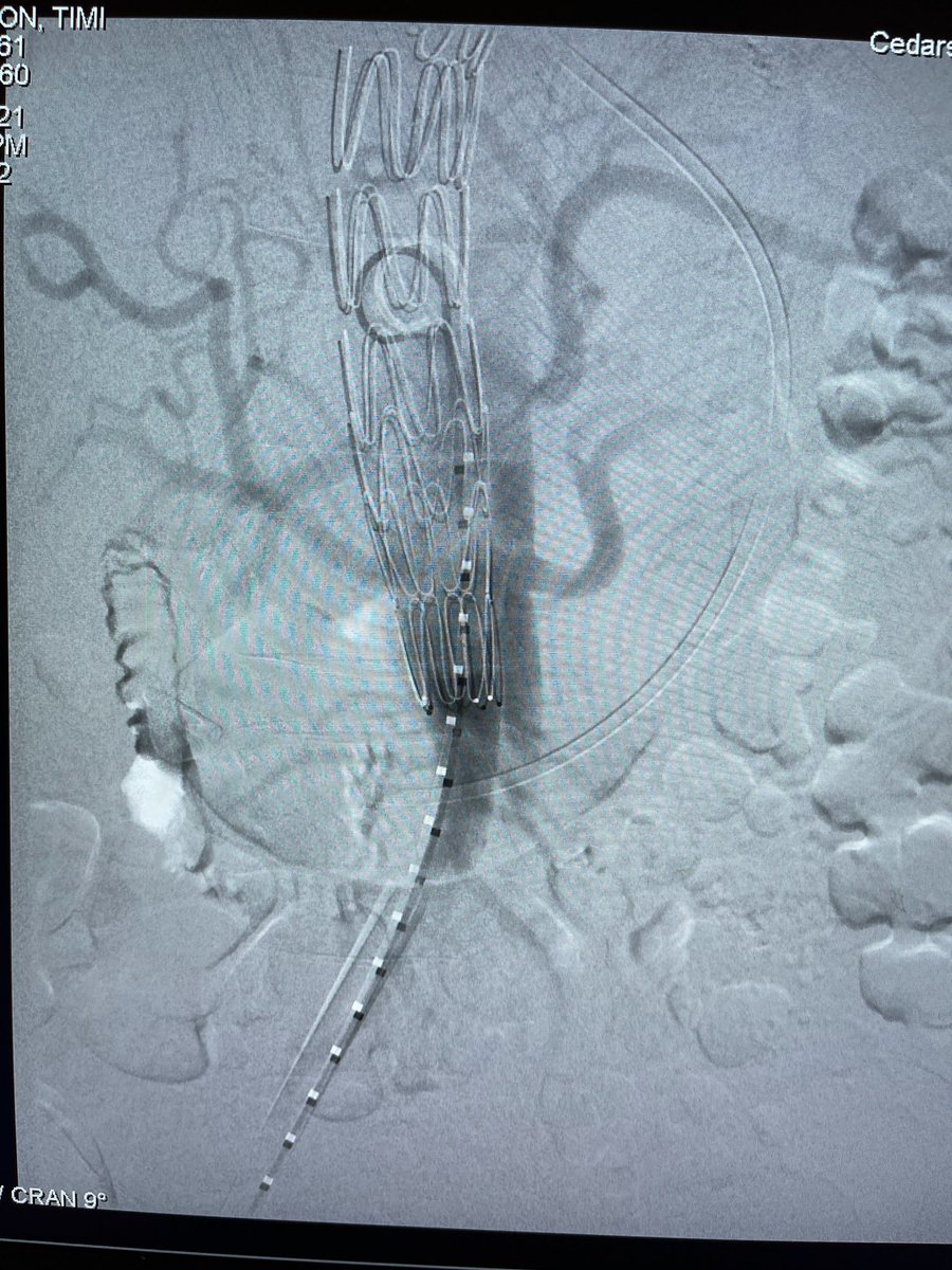 DanielMilesMD (@danielmilesmd) on Twitter photo Subacute TBAD with large FL repaired with #TEVAR and dissection stent - time to remodel! #VascSurg #VascularTwitter #MedEd #SoMe4Surgery <a href="/MoridzadehMD/">Rameen S. Moridzadeh, MD</a> <a href="/VSA_LLC/">Vascular Surgery Associates</a> <a href="/VascularSurgCS/">Cedars-Sinai Division of Vascular Surgery</a> Subacute TBAD with large FL repaired with #TEVAR and dissection stent - time to remodel! #VascSurg #VascularTwitter #MedEd #SoMe4Surgery <a href="/MoridzadehMD/">Rameen S. Moridzadeh, MD</a> <a href="/VSA_LLC/">Vascular Surgery Associates</a> <a href="/VascularSurgCS/">Cedars-Sinai Division of Vascular Surgery</a>