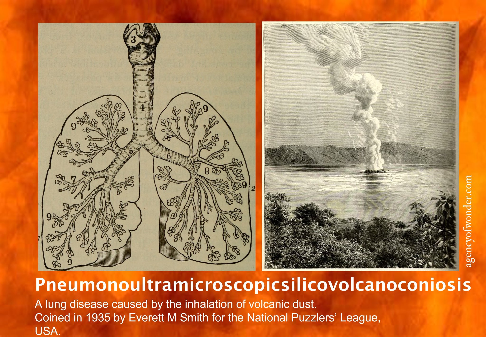 Pneumonoultramicroscopicsilicovolcanoconiosis Disease Hiding In Plain