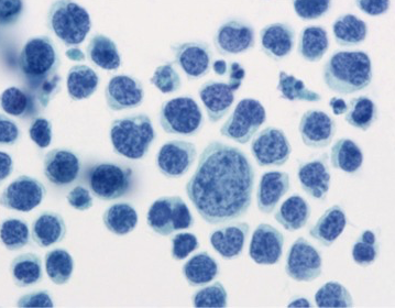 Pathoutlines's tweet photo. We are looking for great microscopic images of pyothorax associated lymphoma. To share any on our site, email them to Nat@PathologyOutlines.com with any clinical history. Radiologic or gross images are great too.
#Microscopy #lymphoma #pyothorax #pathology #Image https://t.co/1I7GGTUoxL