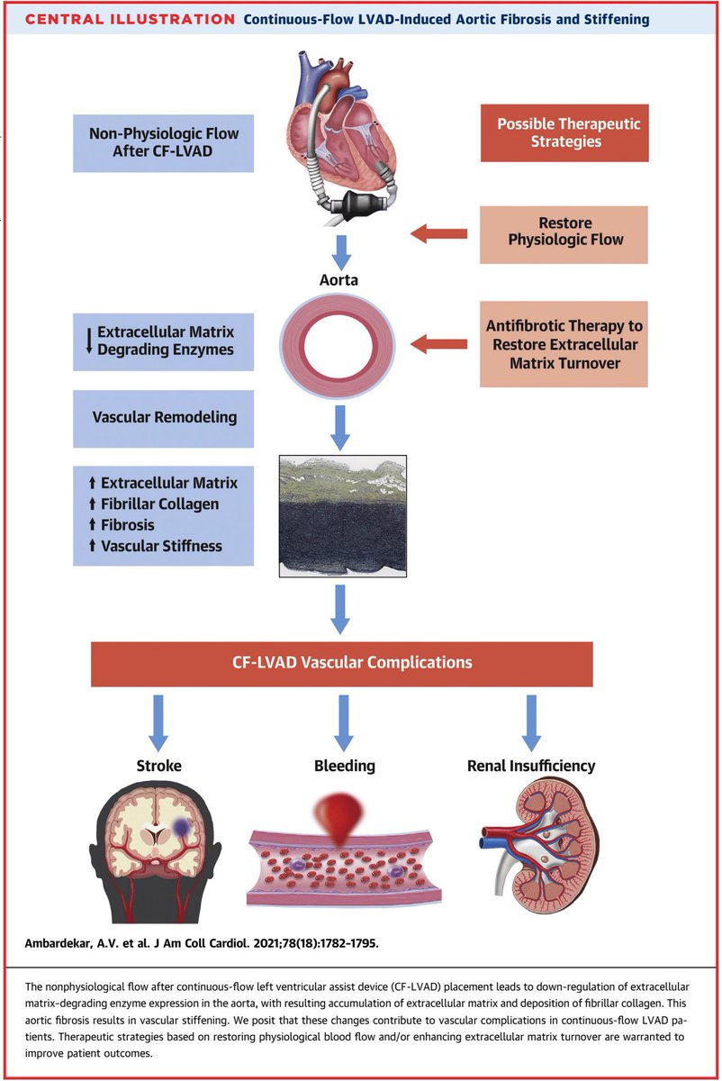 The effects of nonphysiological flow generated by continuous-flow LVADs on the aorta remain poorly understood. 

A new #JACC study shows there is aortic remodeling and fibrosis that correlates with duration of #LVAD support. bit.ly/3B8VPaJ #CardioTwitter