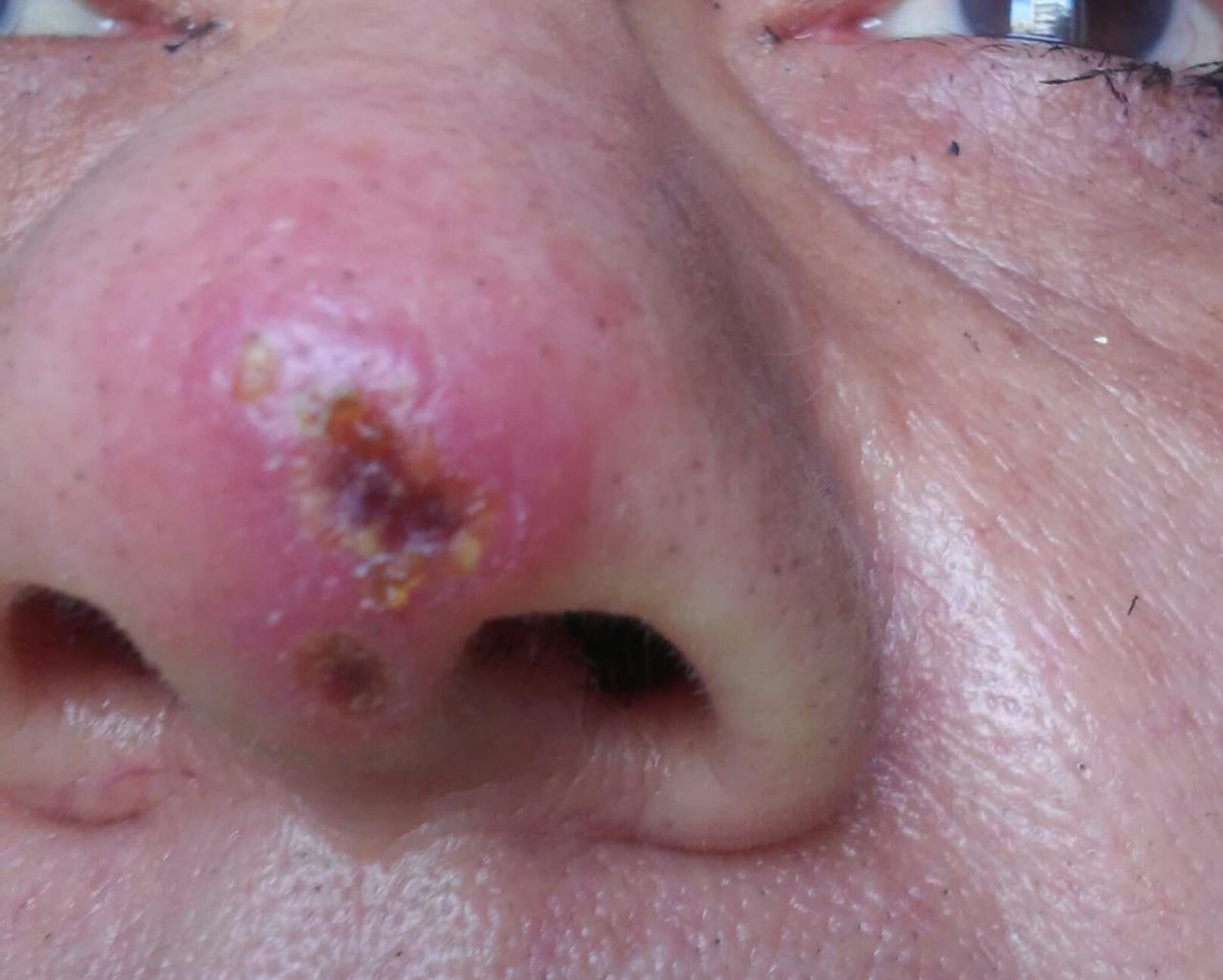 Alexgurka's tweet photo. @Arachno_Cosas muy buena tarde. Al parecer le mordió una araña hace 6 dias(foto) Ha ido al medico 3 veces, primero le dieron antihistamínico con antibiótico, ahora solo antibiótico... Es de ciudad de México, algún lugar o médico que recomiende ir? Sigue empeorando -foto. Gracias https://t.co/cejo82tioW