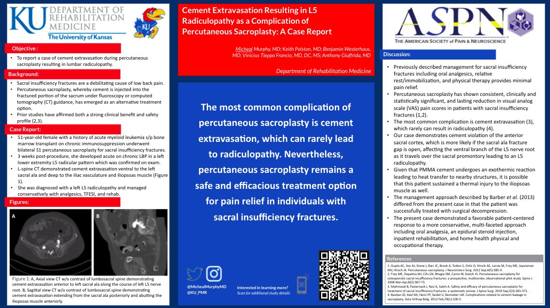 The most common complication of percutaneous sacroplasty is cement extravasation, which can rarely lead to radiculopathy. Sacroplasty still remains a safe treatment option for pain relief in those with sacral insufficiency fractures

<a href="/KU_PMR/">KU PM&R</a> <a href="/KUMedCenter/">KU Medical Center</a> #ASPNAbstracts #18