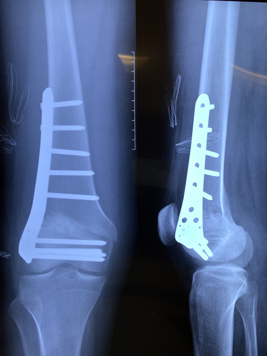 ortopediaabm's tweet photo. Control radiográfico exitoso a las 2 semanas post operado de osteotomia varizante fémur distal tipo Wedge por el diagnóstico de geno-valgo #genovalgo #OrtopediaABM #TraumatologoPuertaDeHierroSur #OrtopedistaPuertaDeHierroSur #CirugiaRodilla #OsteotomiaVarizanteRodilla https://t.co/r2JuUPhSjC