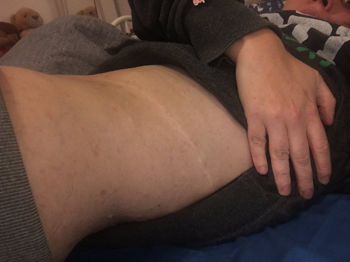 Kirstysstory's tweet photo. I am #DisabledAndBeautiful and so is each and everyone of my #DisabilityCommunity. Each of my scars tell a story and how I became stronger. #BodyPositive #BodyImage https://t.co/VcKlJ6B1yc