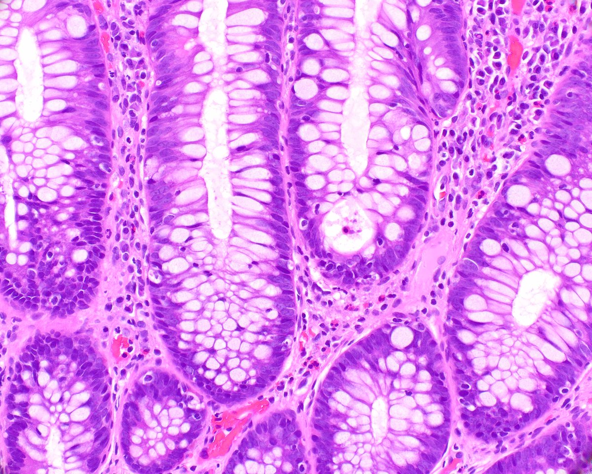 LizMontgomeryMD's tweet photo. Colonic mucosal injury associated with nivolumab.  Lots of lymphocytosis and crypt apoptosis. https://t.co/GreiJIoz5Z
