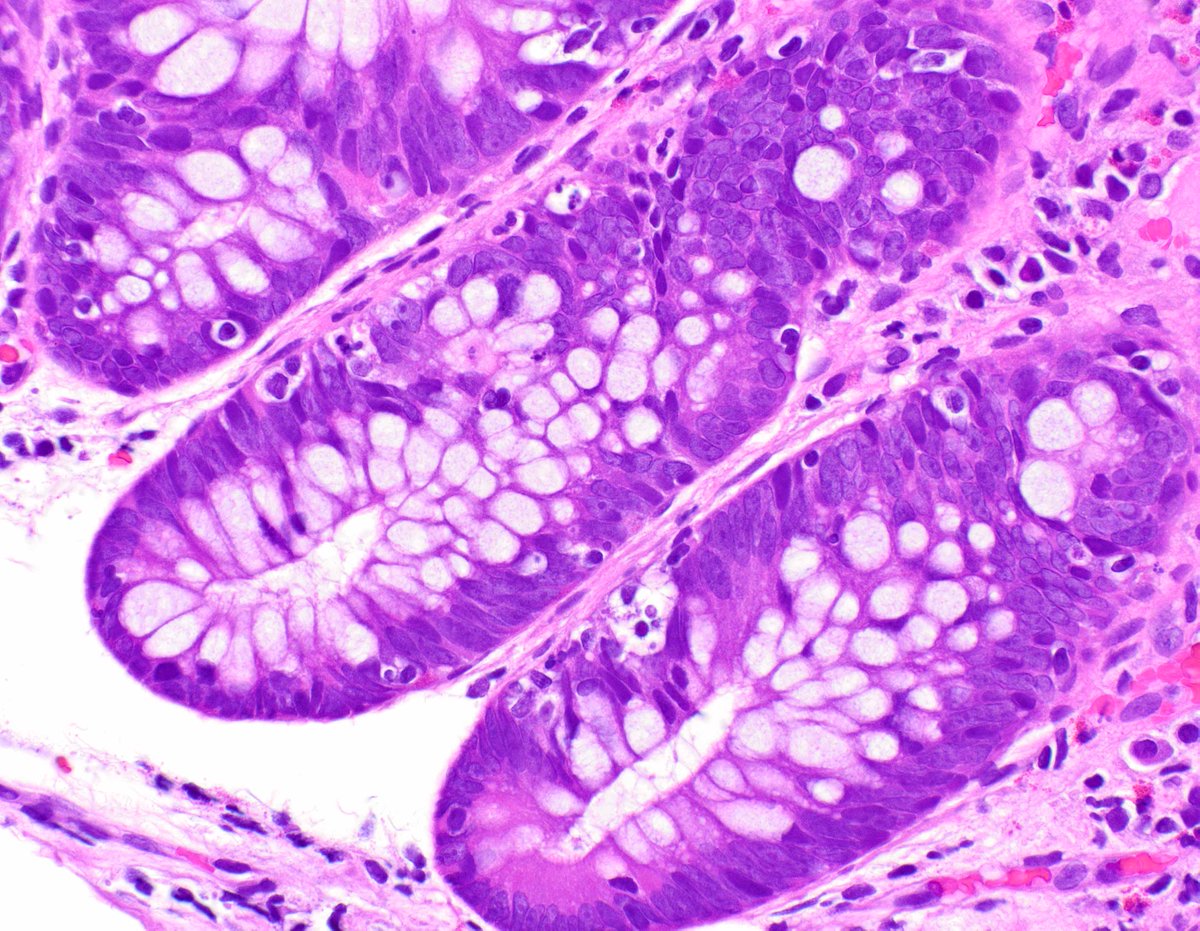 LizMontgomeryMD's tweet photo. Colonic mucosal injury associated with nivolumab.  Lots of lymphocytosis and crypt apoptosis. https://t.co/GreiJIoz5Z