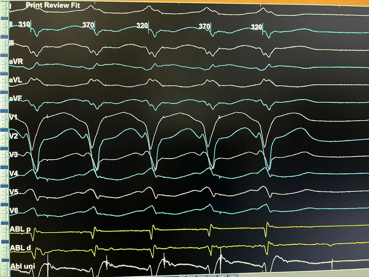 Classical EP tracings for #EPfellows: Referred for idiopathic VT. Atypical AVNRT with PVC peeling back LB refractoriness and a sneaky pseudo-VAAV response to VOD.