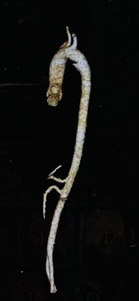 ReVascMed (@revascmed) on Twitter photo It’s not too often that you come across a #PatentDuctusArteriosus that needs to be closed as an adult! But when you do, imaging is key for pre-procedural planning and successful closure. #PennsyInterventions <a href="/SiemensHealth/">Siemens Healthineers</a> <a href="/PennCardiology/">Penn Cardiology</a> <a href="/PennCVFellows/">Penn Cardiology Fellows</a> <a href="/GPAngioClub/">Phila Angio Club</a> <a href="/jcgeorgemd/">Jon George</a> It’s not too often that you come across a #PatentDuctusArteriosus that needs to be closed as an adult! But when you do, imaging is key for pre-procedural planning and successful closure. #PennsyInterventions <a href="/SiemensHealth/">Siemens Healthineers</a> <a href="/PennCardiology/">Penn Cardiology</a> <a href="/PennCVFellows/">Penn Cardiology Fellows</a> <a href="/GPAngioClub/">Phila Angio Club</a> <a href="/jcgeorgemd/">Jon George</a>