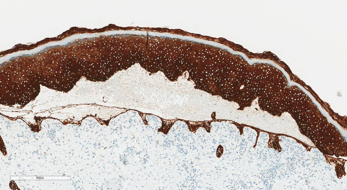 In support of epidermolysis bullosa week, here is the histology of EB simplex.  Acral blisters in an infant.  Note that on H&amp;E andCK5/6 you can see that this is not a subepidermal vesicle- the problem is in the basal keratinocytes.  #dermpath #dermatology #pathology