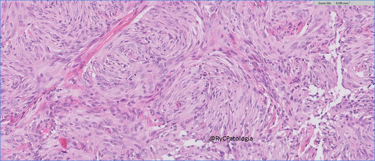 RyCPatologia's tweet photo. ➡️ Mujer, 50 años.
➡️ LOE extraaxilal a nivel occipital.
🔬 Inmunohistoquímica: EMA

☑️ Meningioma fibroso.
#RyCPath #neuropath https://t.co/Yhjp5u8moV